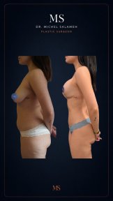 before-after photo liposculpture