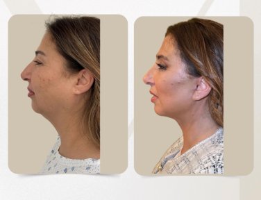 before-after photo tightening-of-facial-skin-facelift