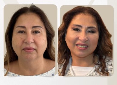 before-after photo tightening-of-facial-skin-facelift