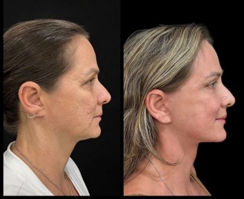 before-after photo tightening-of-facial-skin-facelift