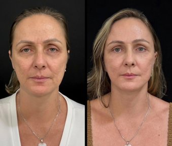 before-after photo tightening-of-facial-skin-facelift
