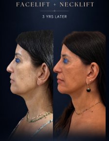 before-after photo tightening-of-facial-skin-facelift