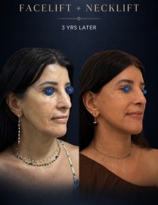 before-after photo tightening-of-facial-skin-facelift