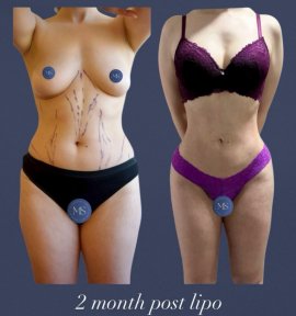 before-after photo lipofilling