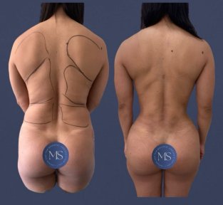 before-after photo lipofilling