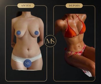 before-after photo lipofilling