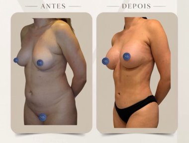 before-after photo lipofilling