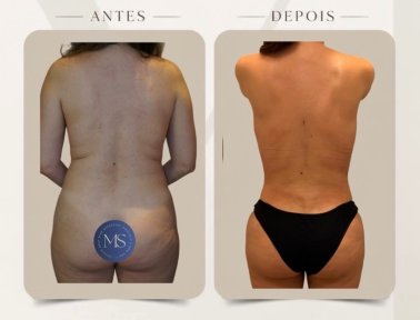 before-after photo lipofilling