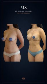 before-after photo lipofilling