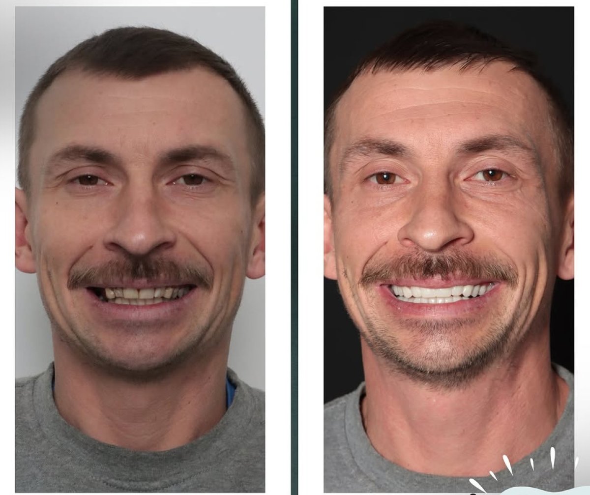 Resultados antes y después de la colocación de coronas dentales: sonrisa y alineación mejoradas