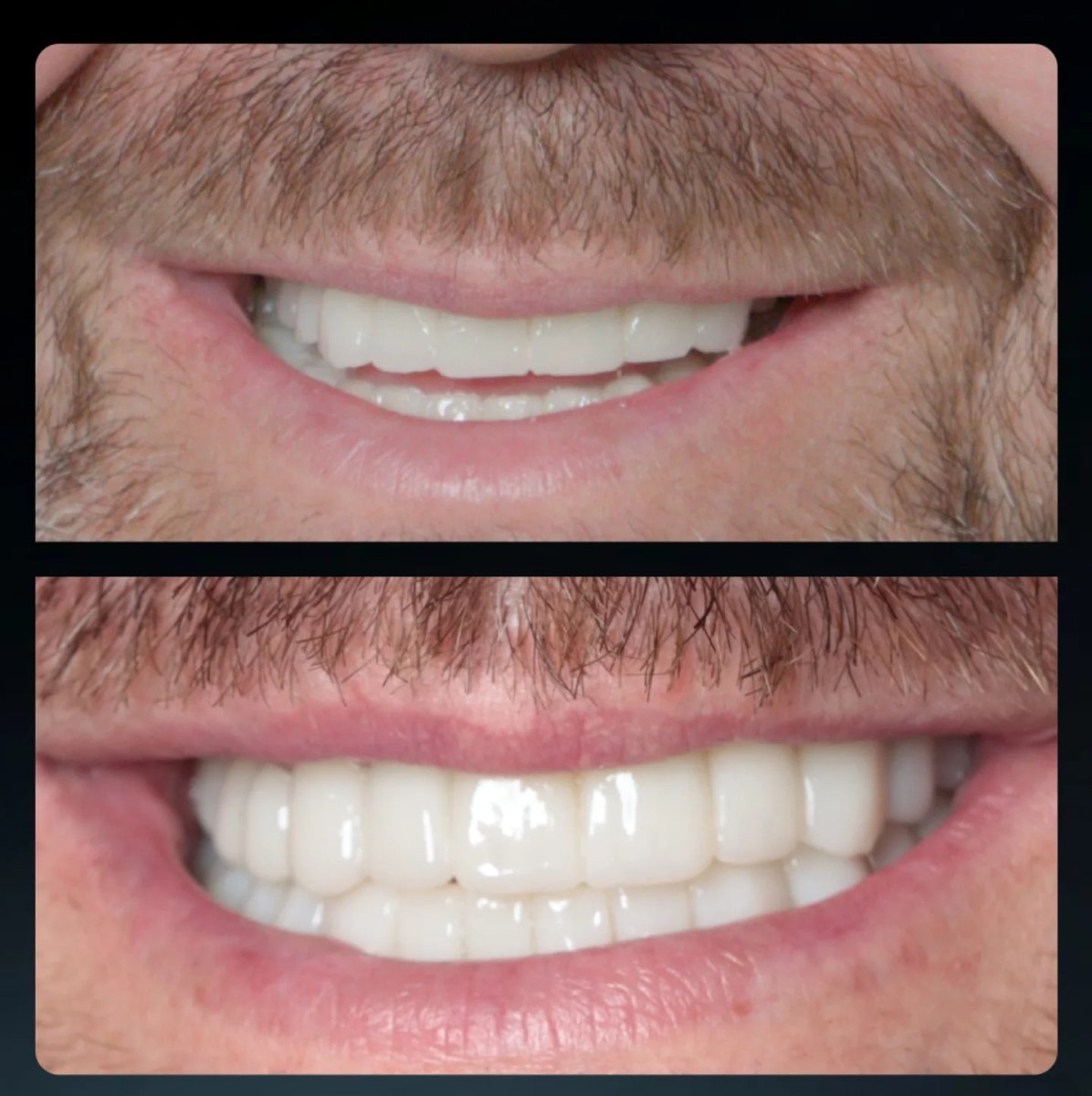 Resultados de blanqueamiento dental antes y después: sonrisa visiblemente más brillante