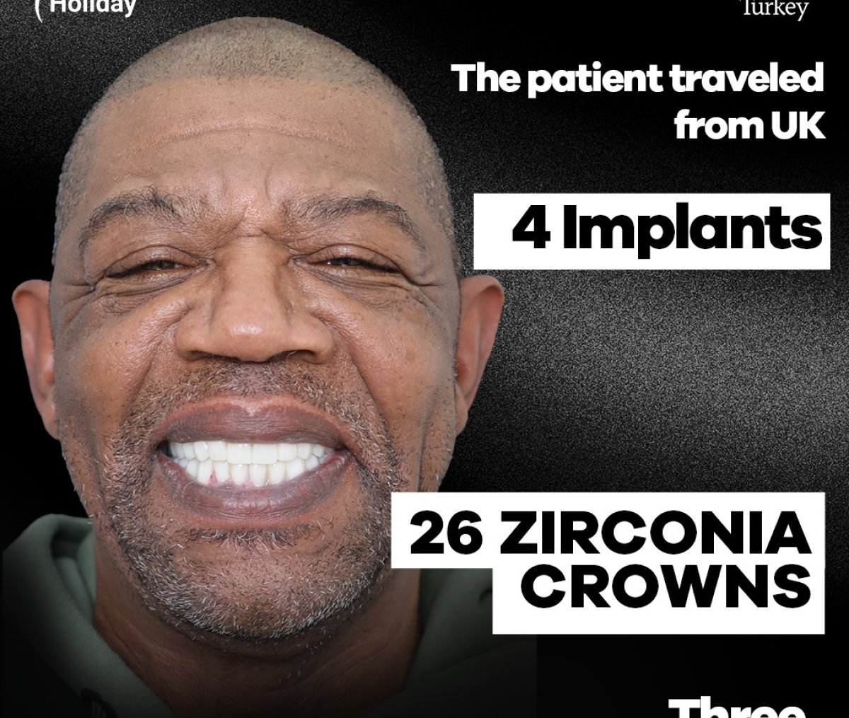 Resultado de sonrisa tras 4 implantes y 26 coronas de zirconio para paciente del Reino Unido en Turquía