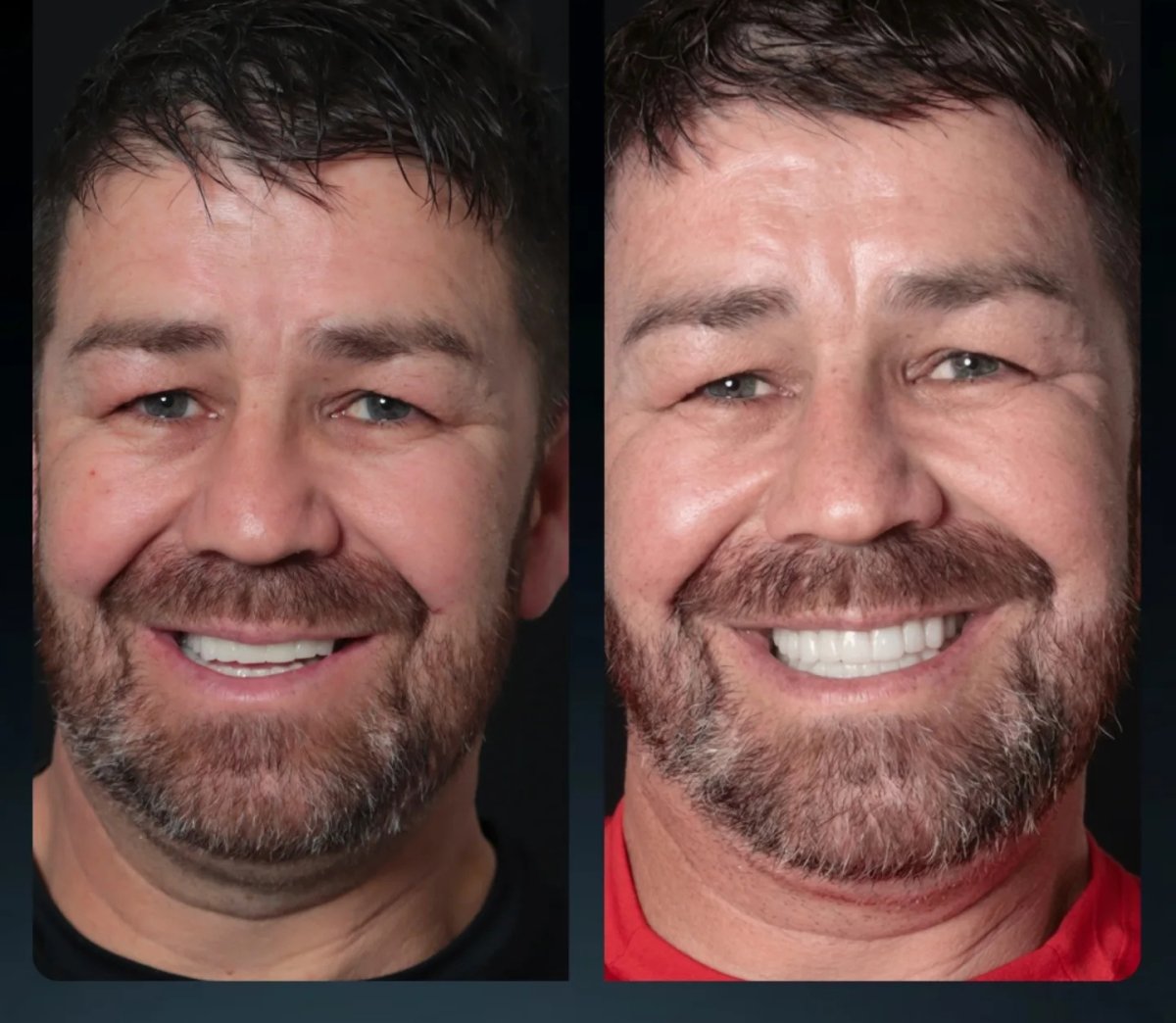 Resultados antes y después de smile makeover en paciente masculino – estética dental mejorada