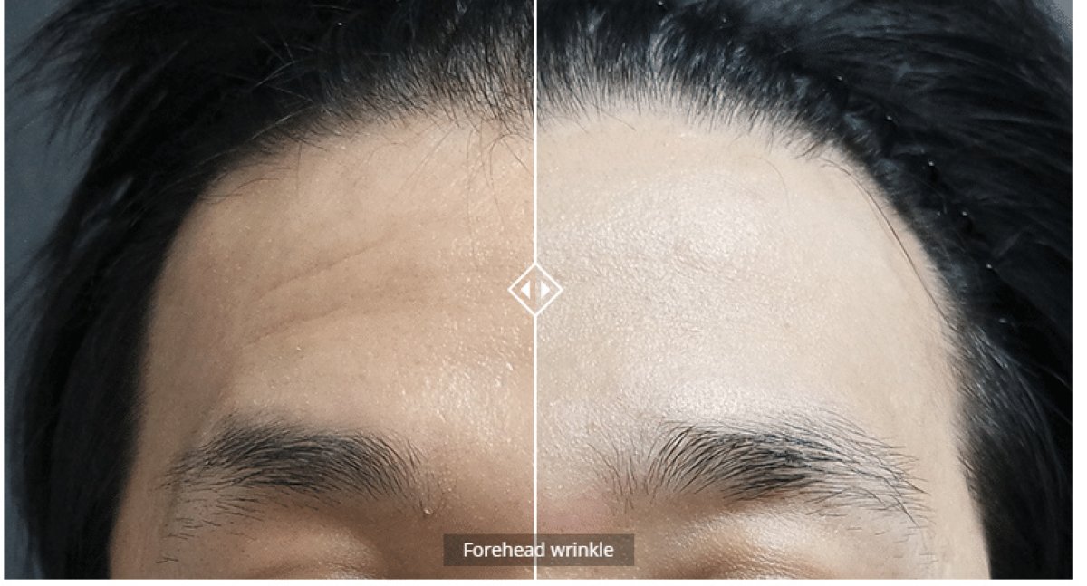 Antes y después de botox para arrugas en la frente, resultado visible en paciente masculino