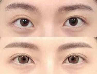 before-after photo upper-eyelid-surgery