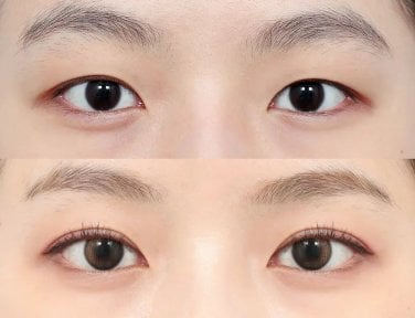 before-after photo upper-eyelid-surgery