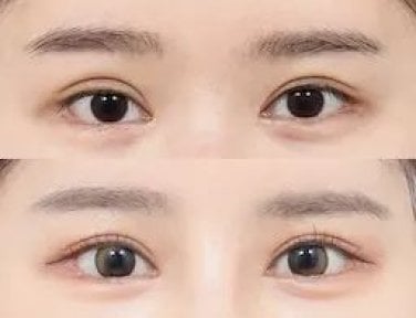 before-after photo upper-eyelid-surgery