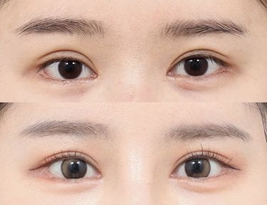 before-after photo upper-eyelid-surgery