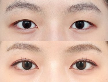 before-after photo upper-eyelid-surgery