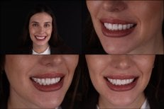 Resultado de Hollywood Smile con carillas dentales en RIKOTA Dental Clinic – dientes blancos y parejos