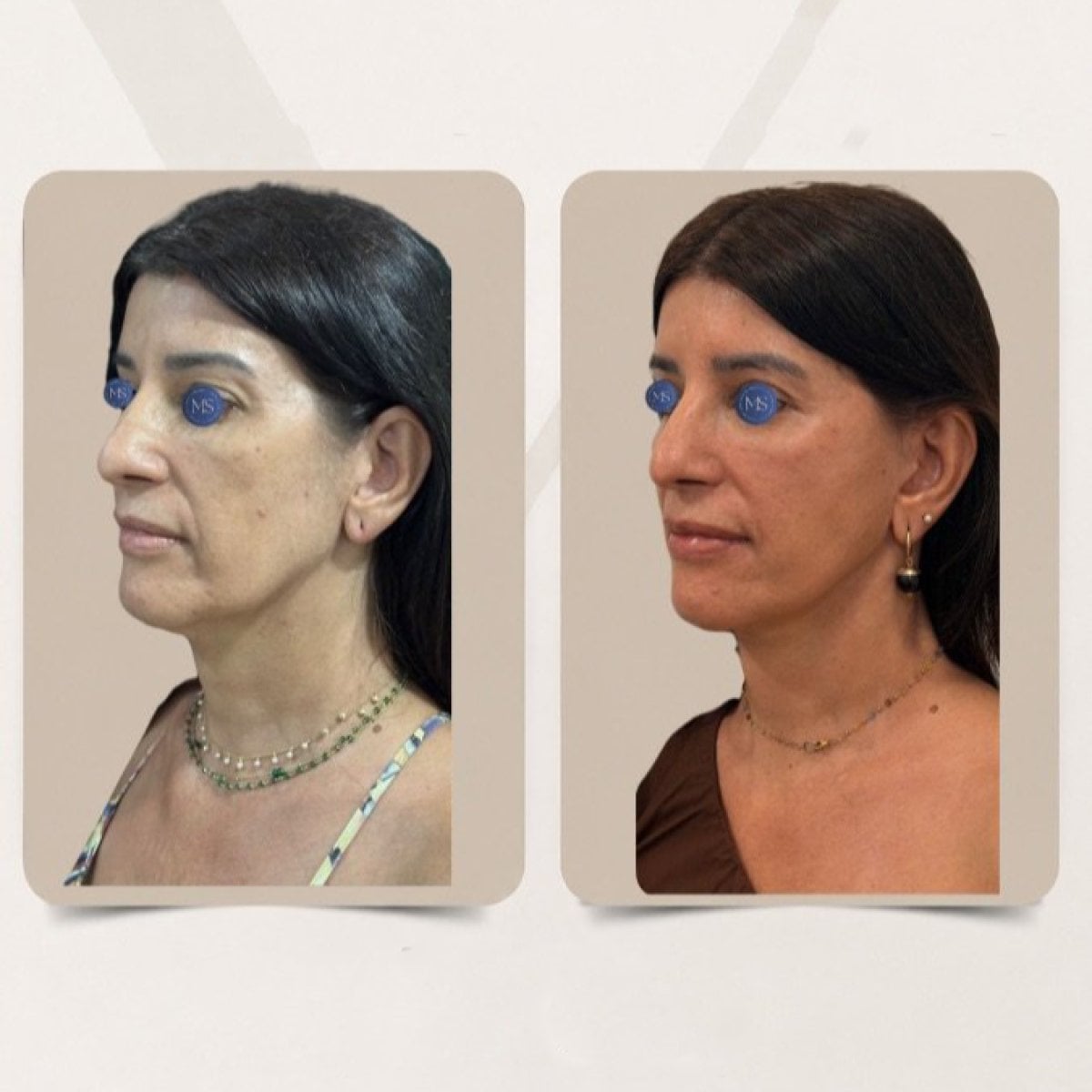 نتائج رأب الجفن قبل وبعد في Dr. Michel Salameh - Plastic And Aesthetic Surgery