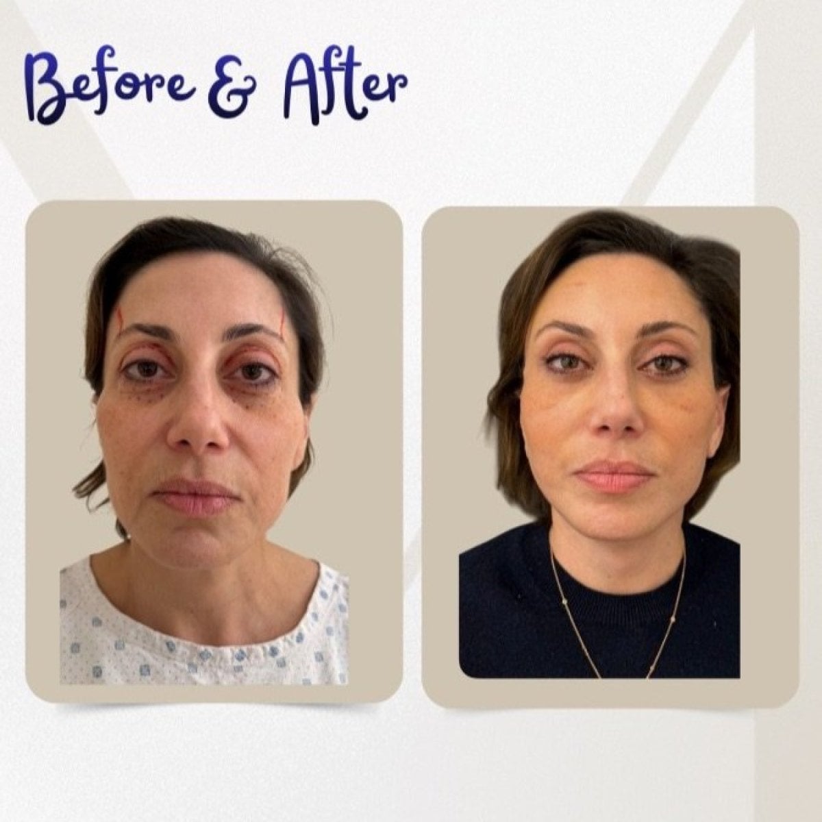 نتائج رأب الجفن قبل وبعد في Dr. Michel Salameh - Plastic And Aesthetic Surgery