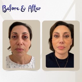 before-after photo blepharoplasty-eyelid