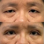 Before and after blepharoplasty results, eyelid correction with reduced puffiness