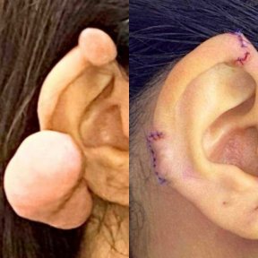 Otoplasty before and after results – ear keloid removal and reshaping procedure outcome