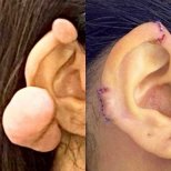 Otoplasty before and after results – ear keloid removal and reshaping procedure outcome