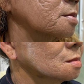 Facelift before and after results – smoother skin and reduced wrinkles on lower face