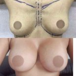 Before and after breast augmentation results – enhanced breast size and contour improvement