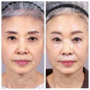 Результаты до и после deep plane facelift – омоложение лица и подтяжка кожи
