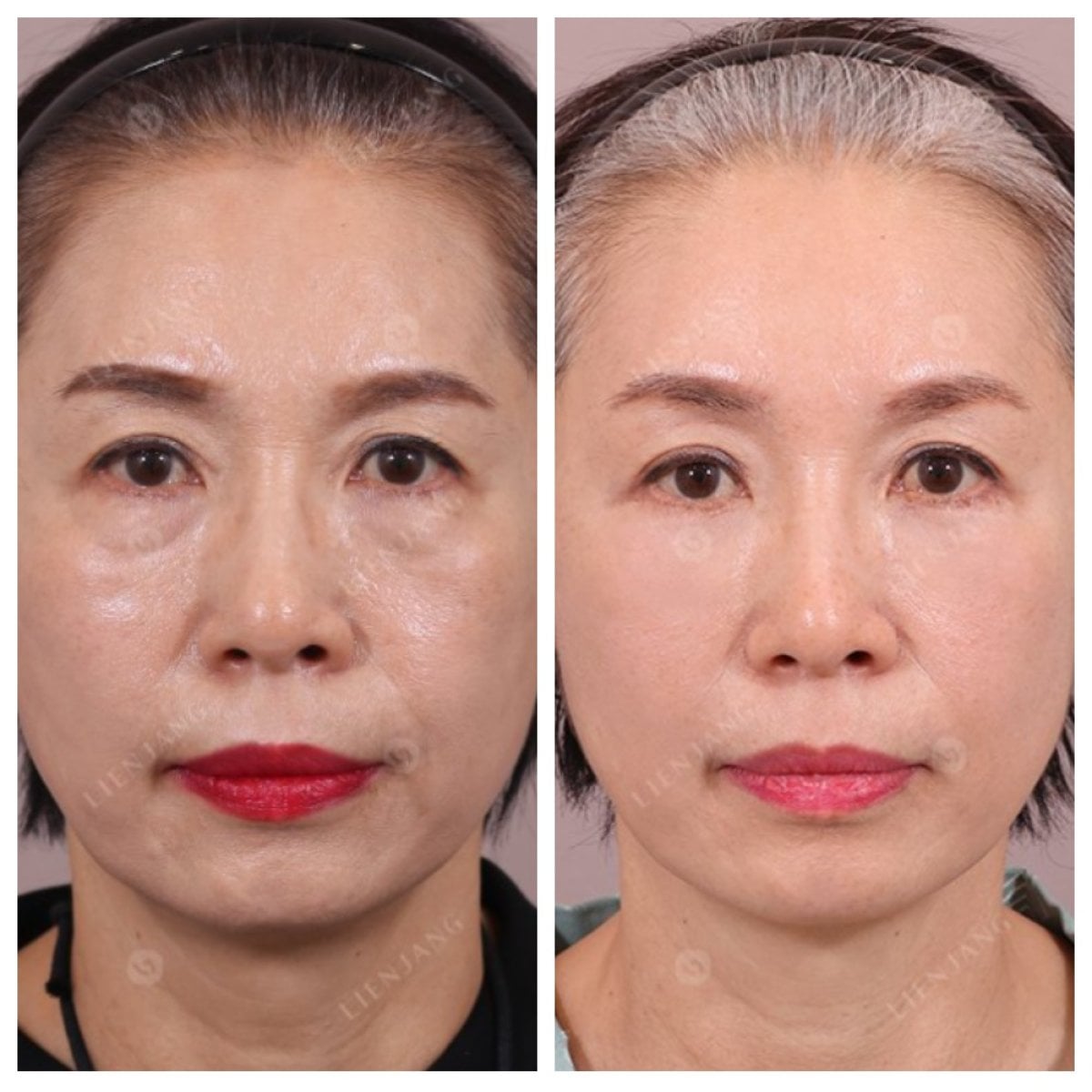 Resultados de minilifting facial antes y después, rejuvenecimiento y piel firme en clínica