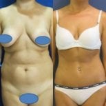 Before and after full body lift results at Memorial Ankara Hospital, improved body contour