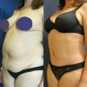 Before and after full body lift results at Memorial Ankara Hospital, improved body contour