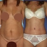 Before and after full body lift results at Memorial Ankara Hospital, improved body contour