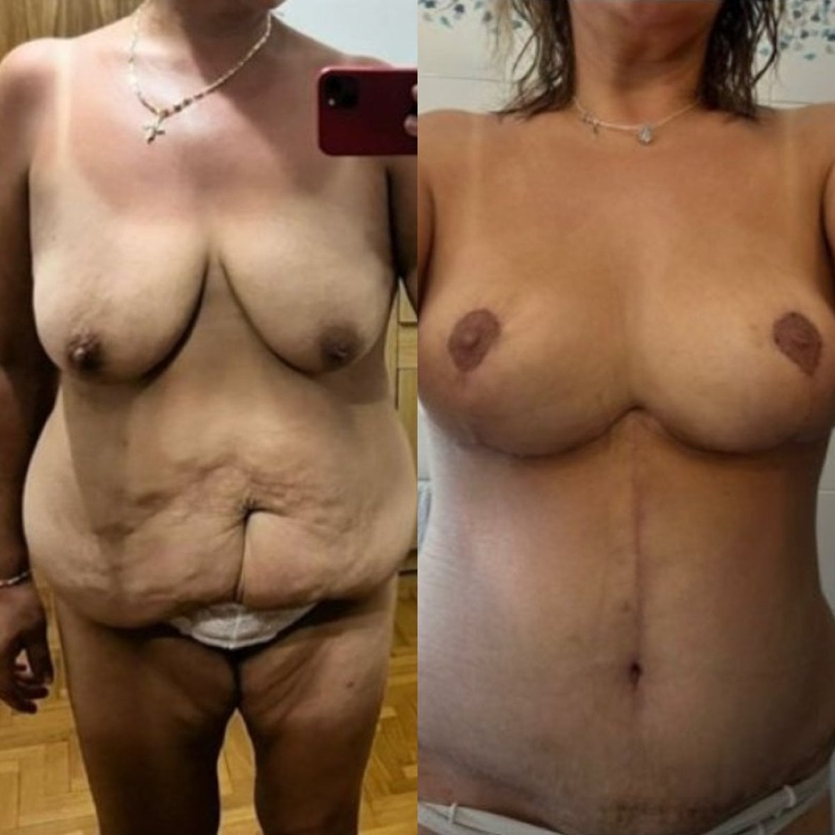 Resultados de lifting corporal completo antes y después en Memorial Ankara Hospital – mejor contorno