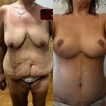 Full body lift before and after results at Memorial Ankara Hospital – improved body contour