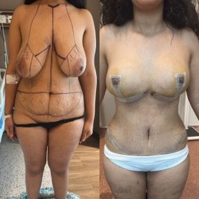 Before and after full body lift results at Memorial Ankara Hospital, improved body contour