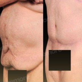 before-after photo lower-body-lift