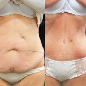 before-after photo lower-body-lift
