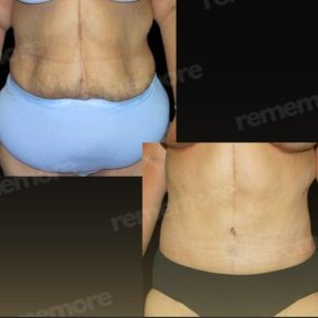 before-after photo lower-body-lift