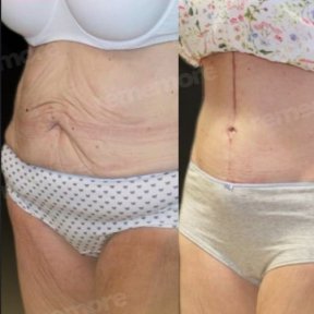 before-after photo lower-body-lift