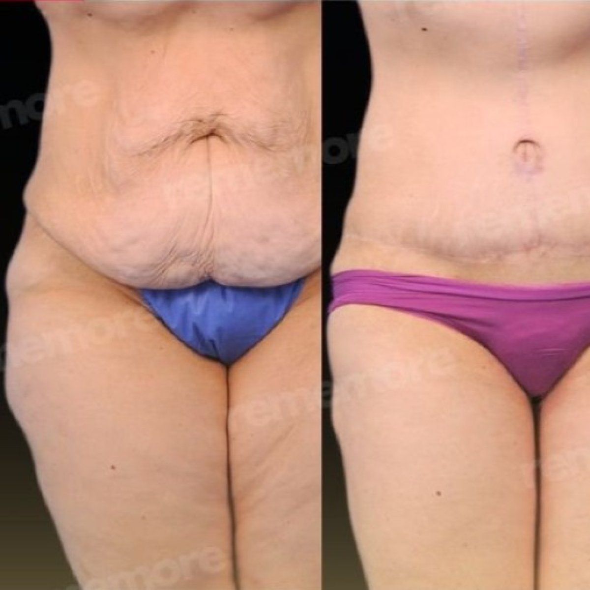 Resultados antes y después de lifting corporal inferior en Memorial Bahçelievler Hospital, contorno abdominal