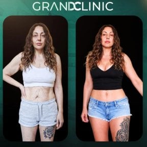 before-after photo abdominoplastika