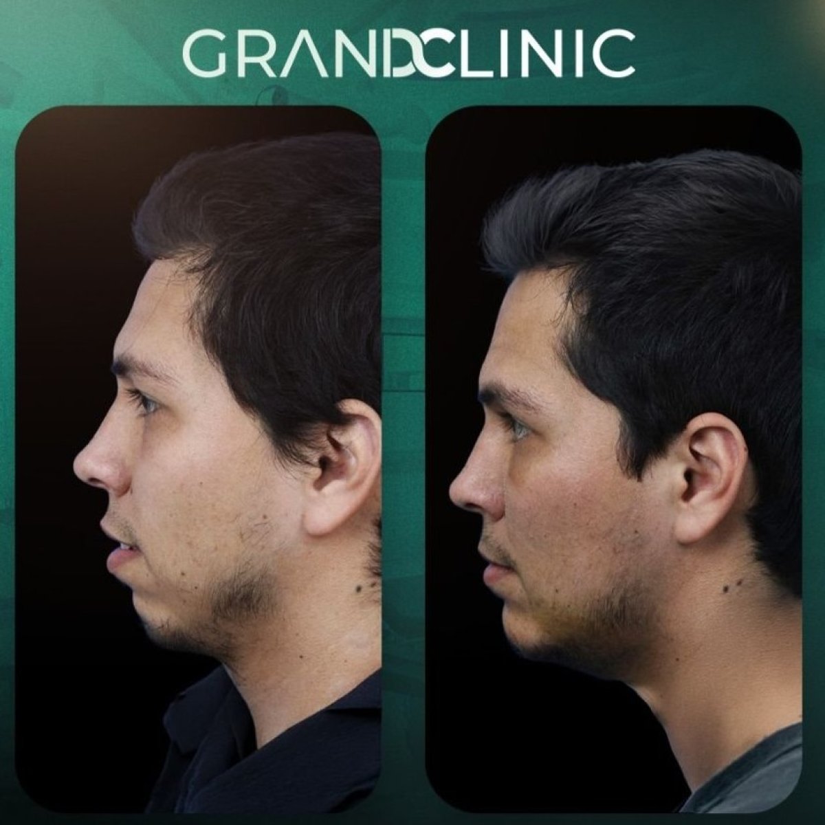 Resultados antes y después de implante de mentón en Grand Clinic, perfil mejorado del mentón
