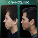 نتائج قبل وبعد زراعة الذقن في Grand Clinic، تحسين شكل وملامح الذقن