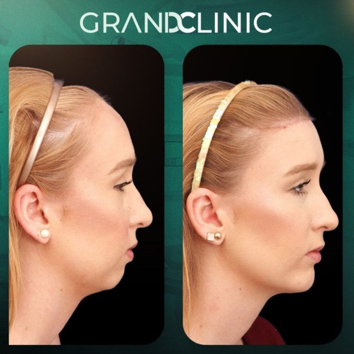 نتائج قبل وبعد زراعة الذقن في Grand Clinic، تحسين شكل وملامح الذقن