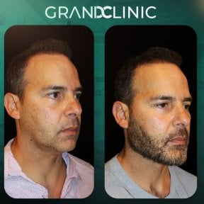before-after photo mentoplastika-plastika-podborodka